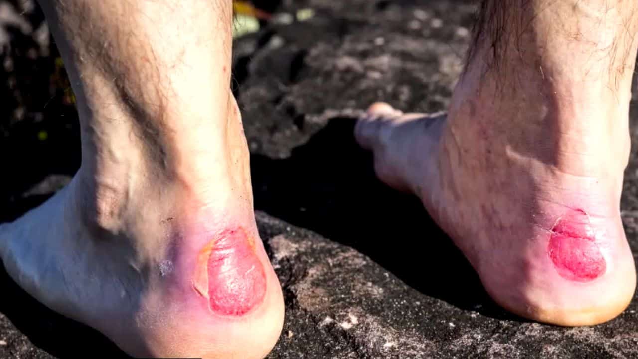 Hiking Blisters